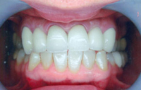 Dental Implants In Hyderabad