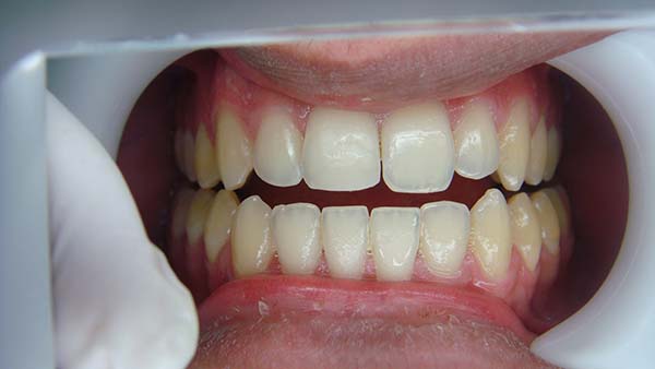 Cosmetic Dentistry Services At Sanath Nagar