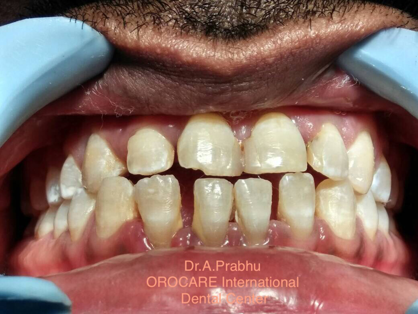 Dental Bone Graft Treatment In Hyderabad