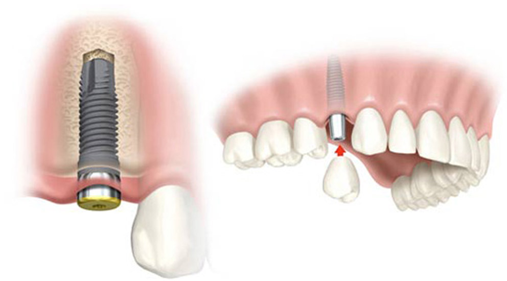 Dental Implant Centre Motinagar