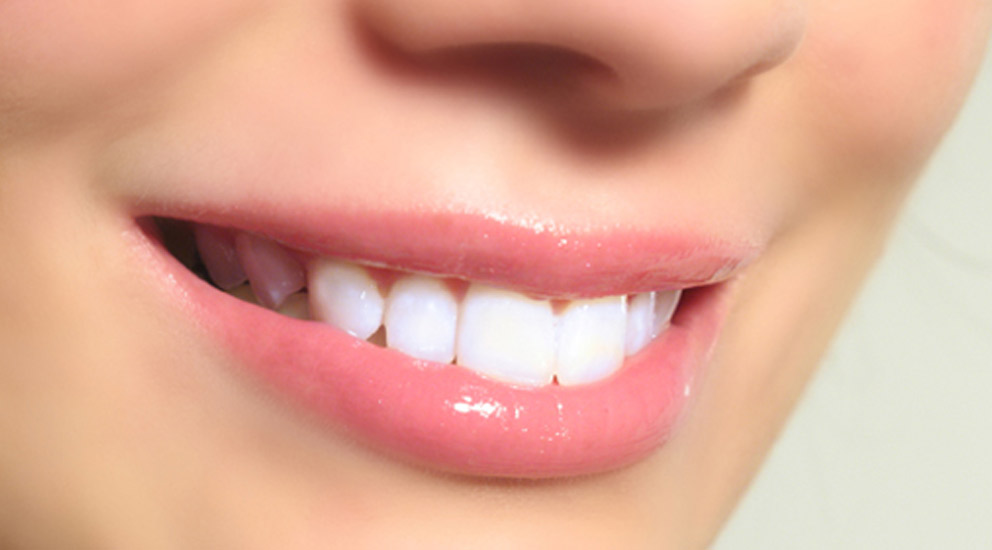 Porcelain Veneer Dental Clinic in Sanath Nagar