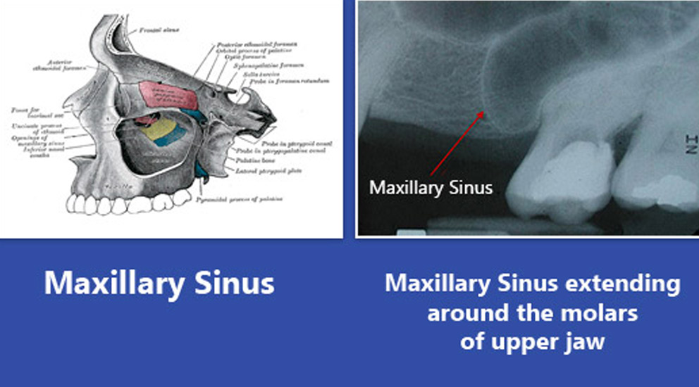 Sinus Lift in Hyderabad