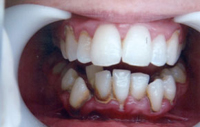 Tooth Whitening Hyderabad